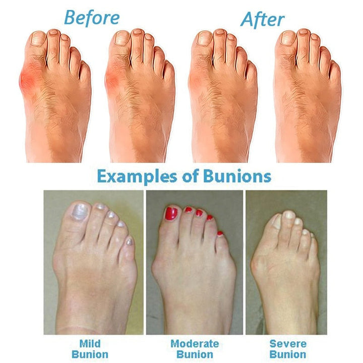 Women's Bunion Corrector Sandals