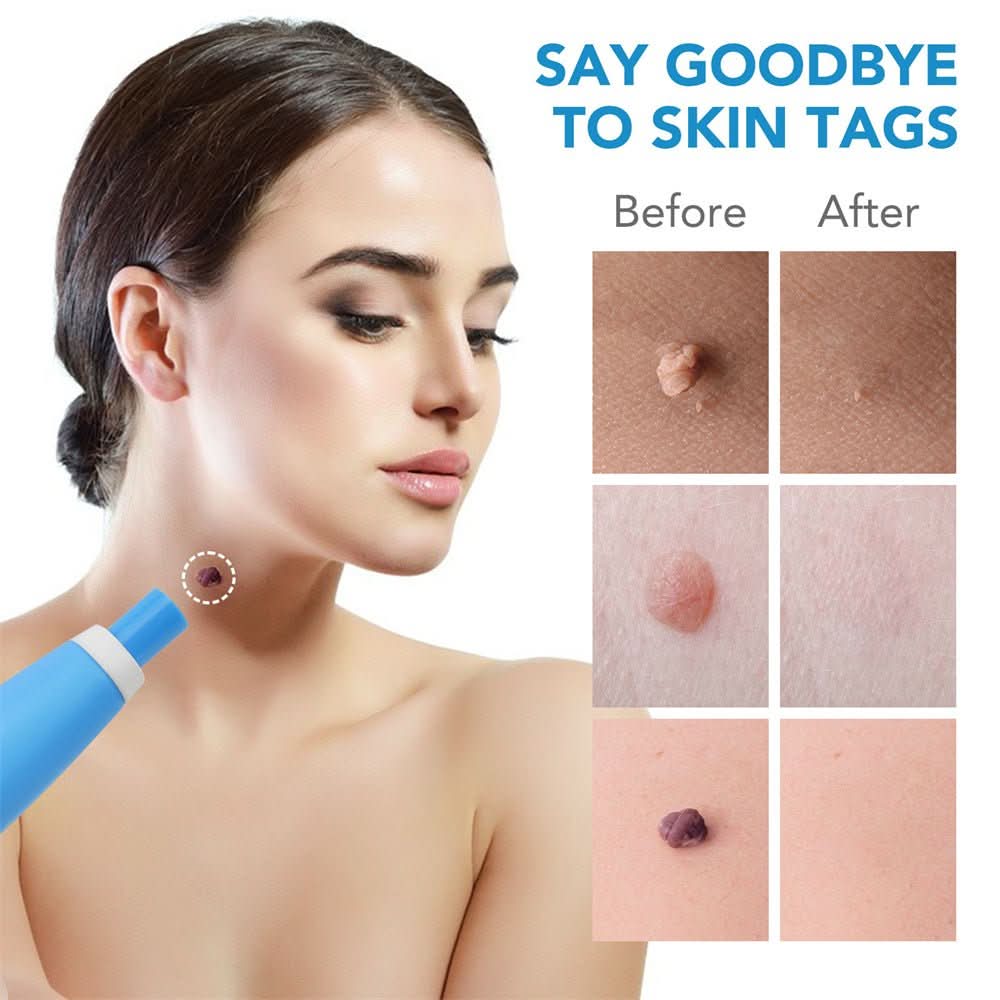 Essential beauty care kit for removing skin tags & warts. Promotes flawless skin with an effective home treatment.