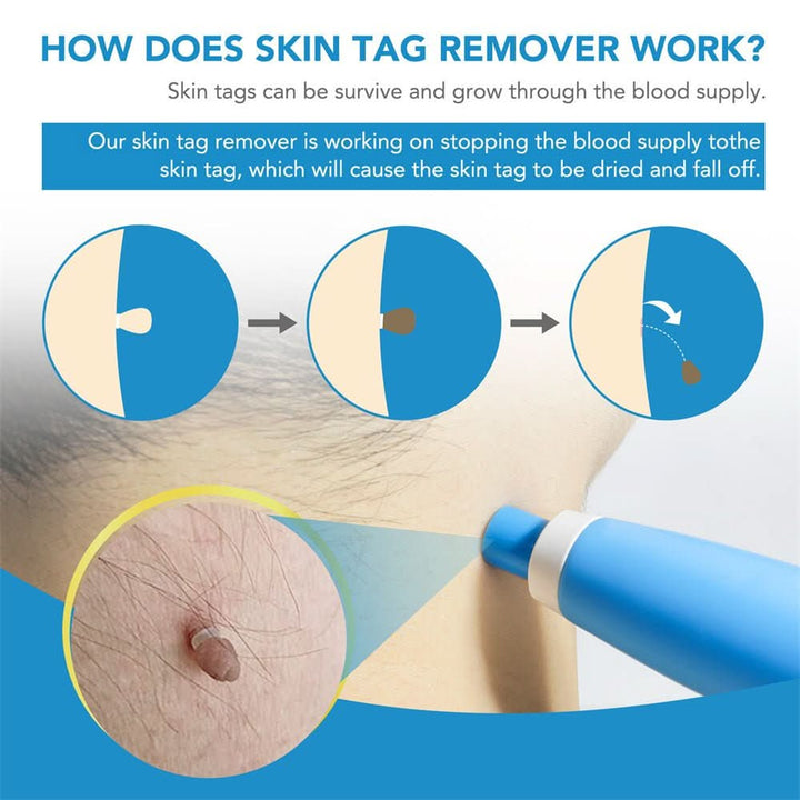 Get clear, smooth skin with this unisex skin tag & wart remover kit. Fast & painless blemish removal solution.