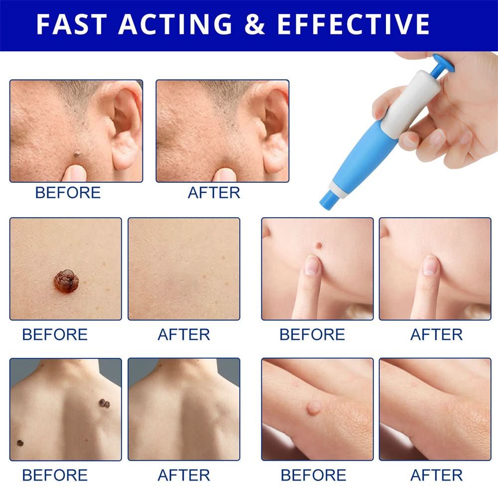 Before & after transformation with a painless skin tag & wart remover kit for men & women. Clear, healthy skin.