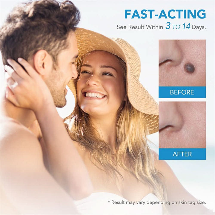 Home treatment beauty kit for effective removal of skin tags and warts, revealing clear and smooth skin.