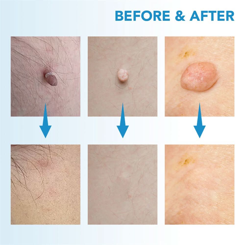 A unisex kit designed for quick & effective skin tag & wart removal. Get flawless, smooth skin at home.