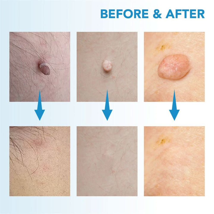 A unisex kit designed for quick & effective skin tag & wart removal. Get flawless, smooth skin at home.