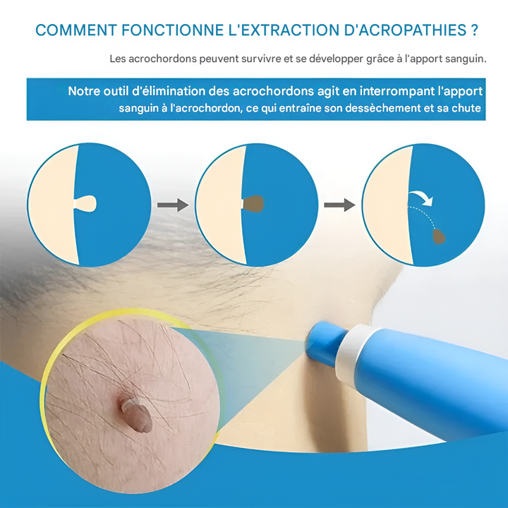 Easy at-home skin tag removal with cryotherapy, providing clear, smooth skin for enhanced wellness and beauty.