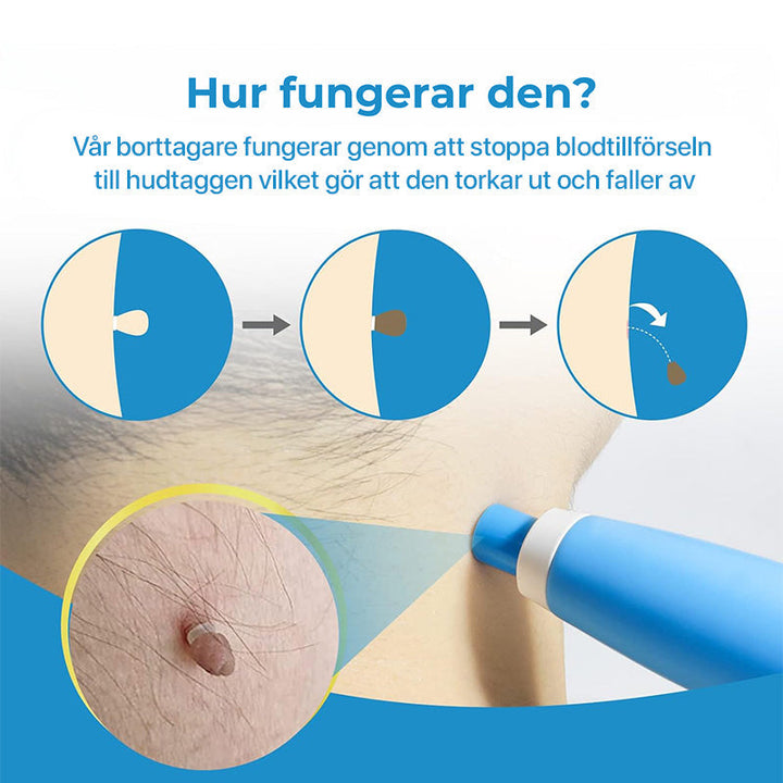 Natural solution dermatology tool: home kit for painless skin tag & blemish removal, promoting clear skin.